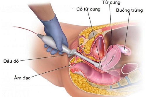 Siêu âm đầu dò có lợi và hại như thế nào đối với mẹ bầu