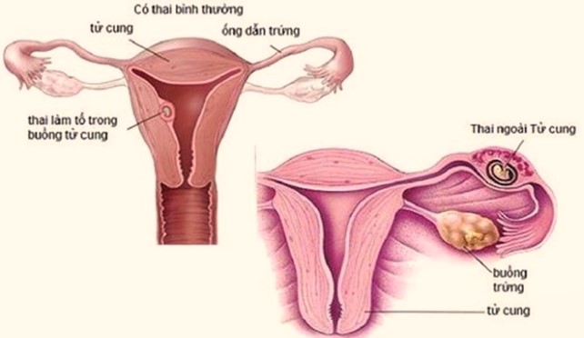 Chửa ngoài tử cung gây nguy hiểm như thế nào ?