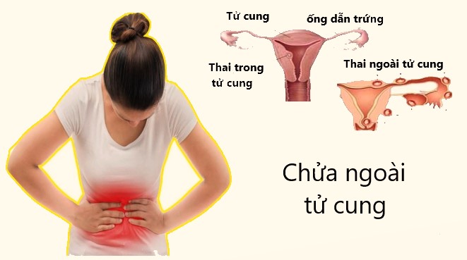 Tổng hợp các kiến thức về chửa ngoài tử cung