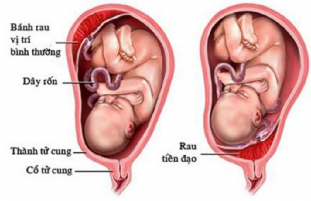 CẢNH BÁO: BIẾN CHỨNG NGUY HIỂM CỦA RAU TIỀN ĐẠO