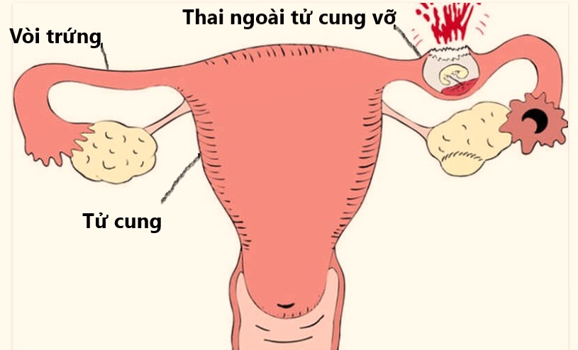 Vỡ chửa ngoài tử cung đe dọa tính mạng mẹ bầu