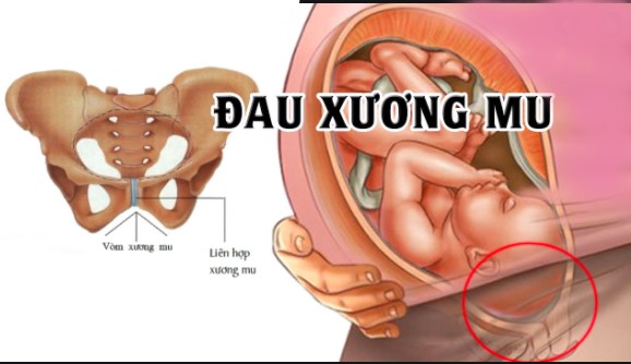 Mẹ bầu phải làm gì khi bị đau xương mu ?