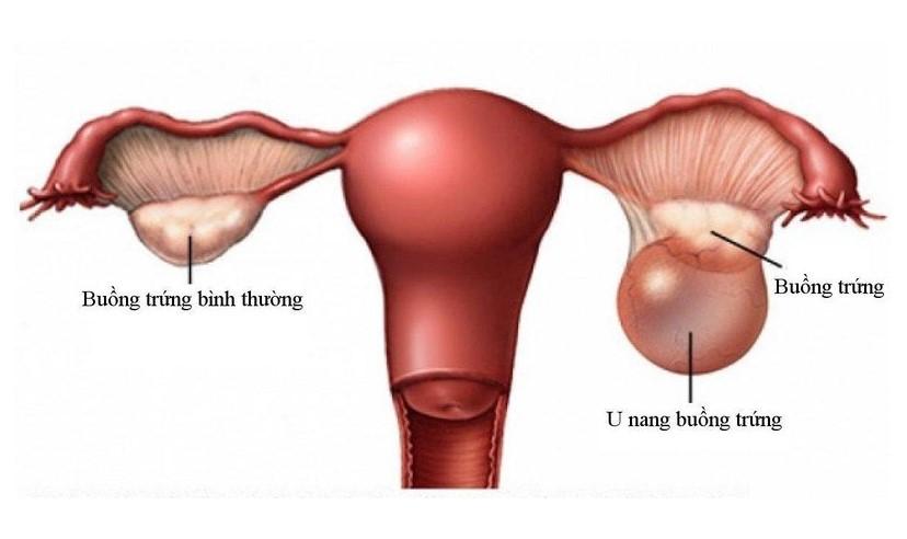 Xử trí và điều trị u buồng trứng khi có thai