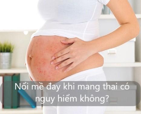 Nổi mề đay khi mang thai có nguy hiểm không?