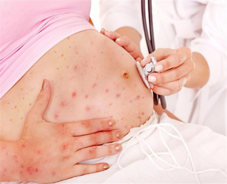 Mắc bệnh thủy đậu khi mang thai nguy hiểm như thế nào?