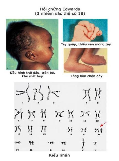 Tìm hiểu về hội chứng Edwards – Trisomy 18