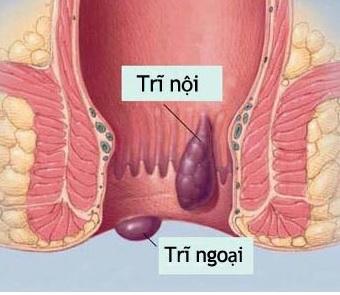 Nguyên nhân mắc trĩ khi mang thai