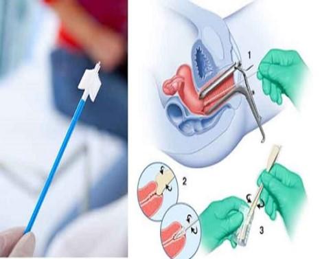 MỘT SỐ XÉT NGHIỆM SÀNG LỌC CƠ BẢN TRONG UNG THƯ CỔ TỬ CUNG