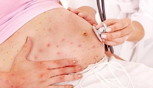 Tại sao cần xét nghiệm Rubella khi mang thai?