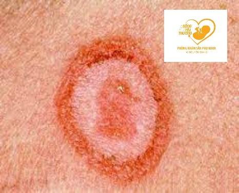 Bệnh lây truyền qua đường tình dục - Bệnh giang mai