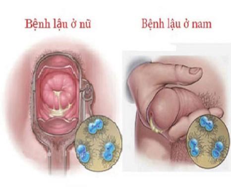 Triệu chứng và dấu hiệu của bệnh lậu
