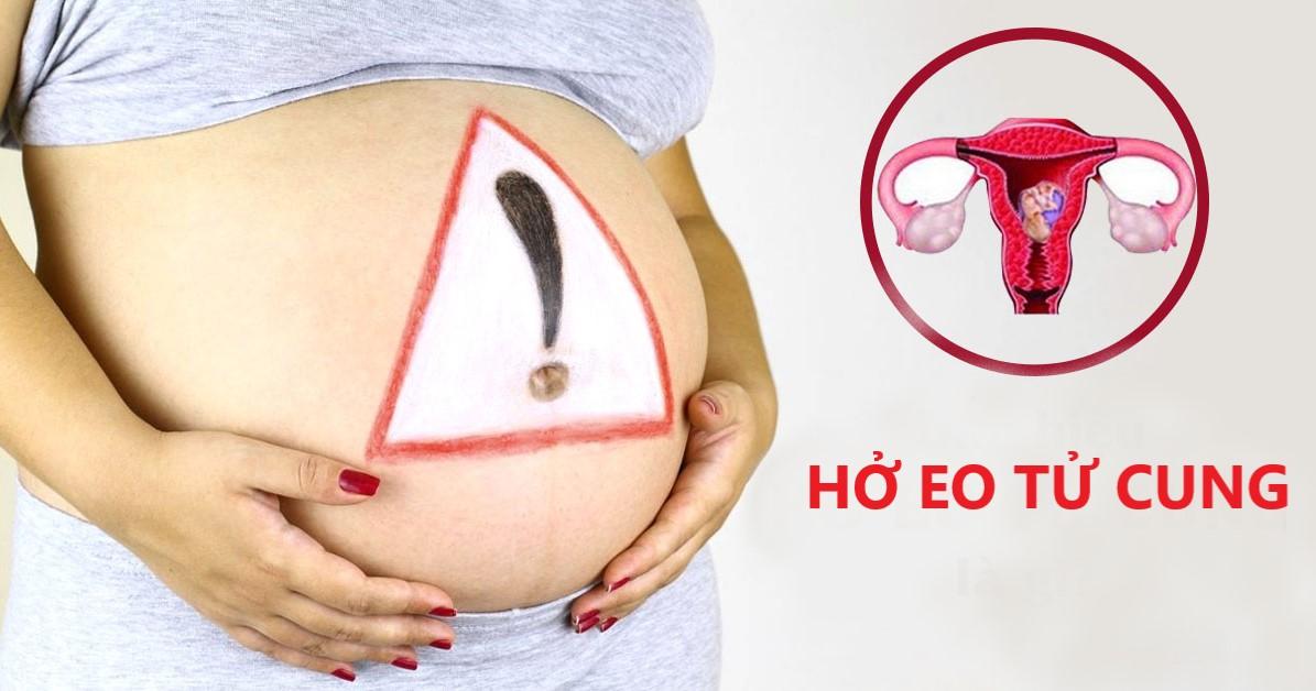 Hở eo tử cung-những điều bạn cần biết