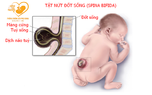DỊ TẬT THAI NỨT ĐỐT SỐNG BẨM SINH