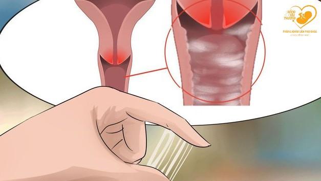 Viêm âm đạo do trùng roi (Trichomonas vaginalis)