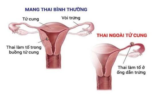 Chửa ngoài tử cung có biểu hiện gì?
