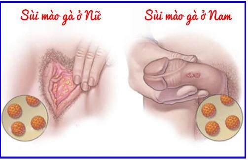 Sùi mào gà sinh dục