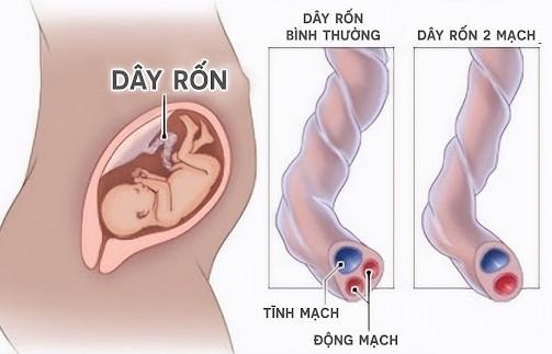 Dây rốn hai mạch máu