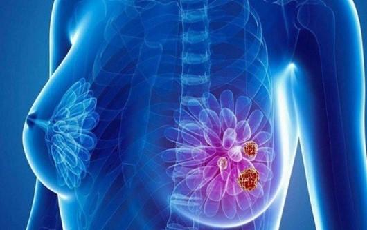 Dấu hiệu nhận biết sớm về ung thư vú