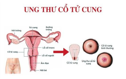 Ung thư cổ tử cung và những điều bạn nên biết