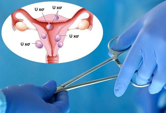 Mổ bóc tách u xơ tử cung như thế nào?