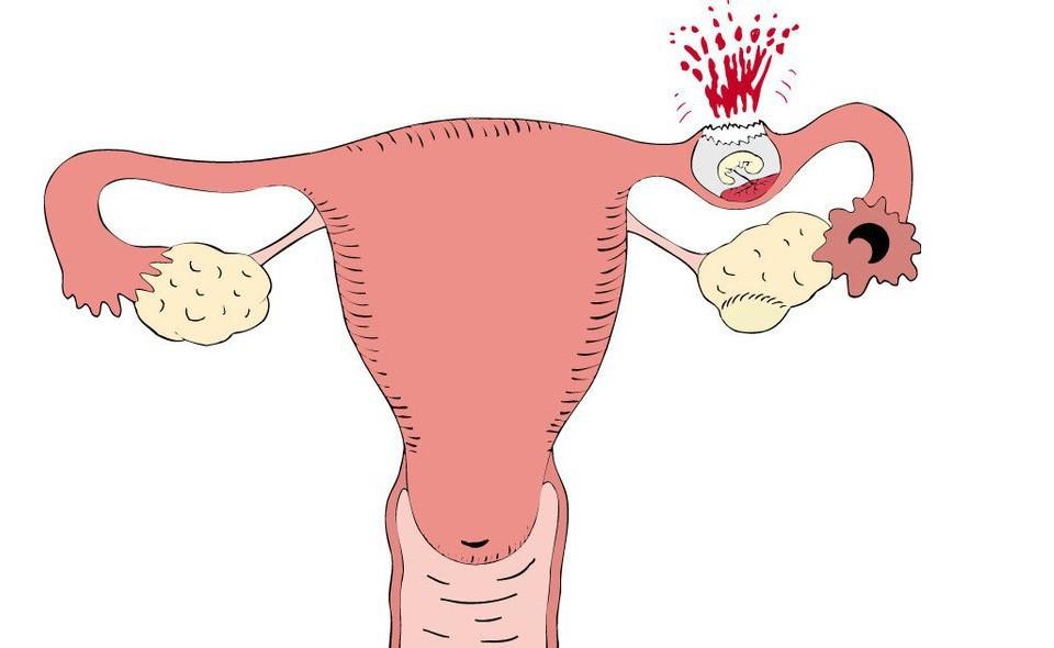 Vỡ tử cung-tai biến sản khoa nguy hiểm