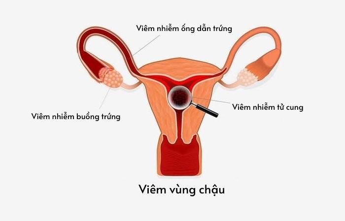 Viêm vùng chậu có ảnh hưởng đến chức năng sinh sản không?