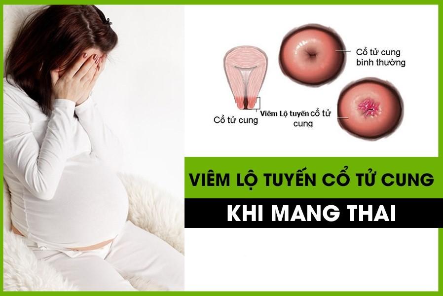 Viêm lộ tuyến cổ tử cung khi mang thai