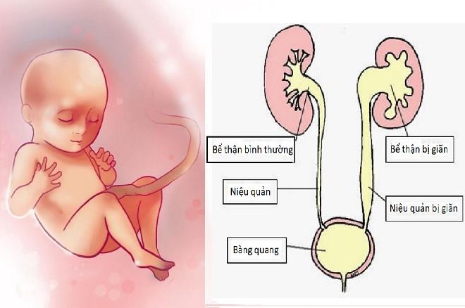 Giãn đài bể thận ở thai nhi có nguy hiểm không?