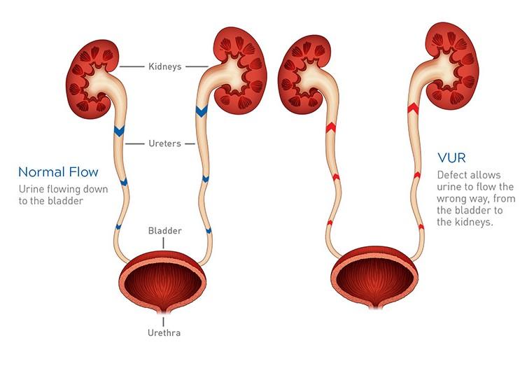 Trào ngược bàng quang-niệu quản ở trẻ nhỏ