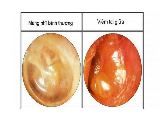 Tại sao trẻ dễ bị viêm tai giữa