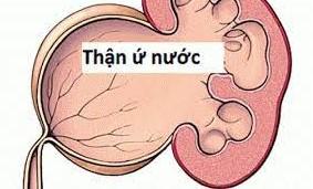 Thận ứ nước: Nguyên nhân, triệu chứng và cách phòng ngừa