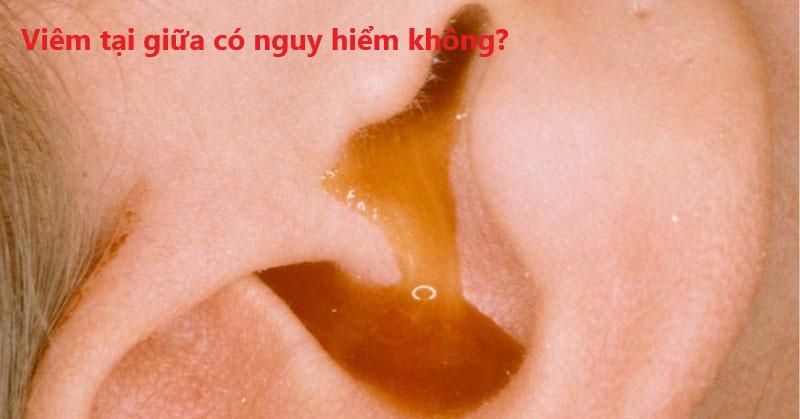 Viêm tai giữa ở trẻ em có nguy hiểm không?