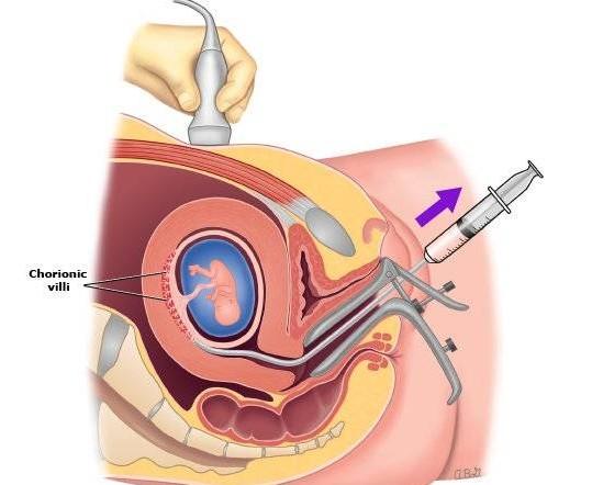 Tầm quan trọng của sinh thiết gai rau