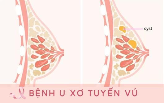 U xơ tuyến vú và những điều cần biết?
