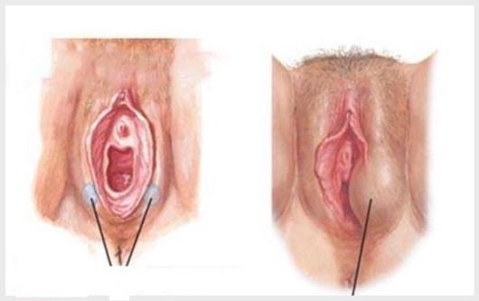 Viêm tuyến Bartholin và nhưng điều cần biết?