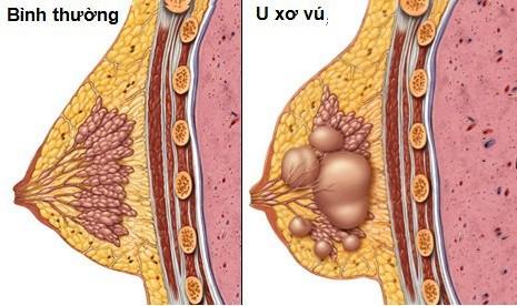 Bệnh u xơ tuyến vú và những điều cần biết