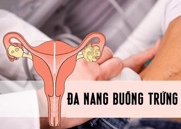 Biện pháp giúp người bị đa nang buồng trứng dễ thụ thai