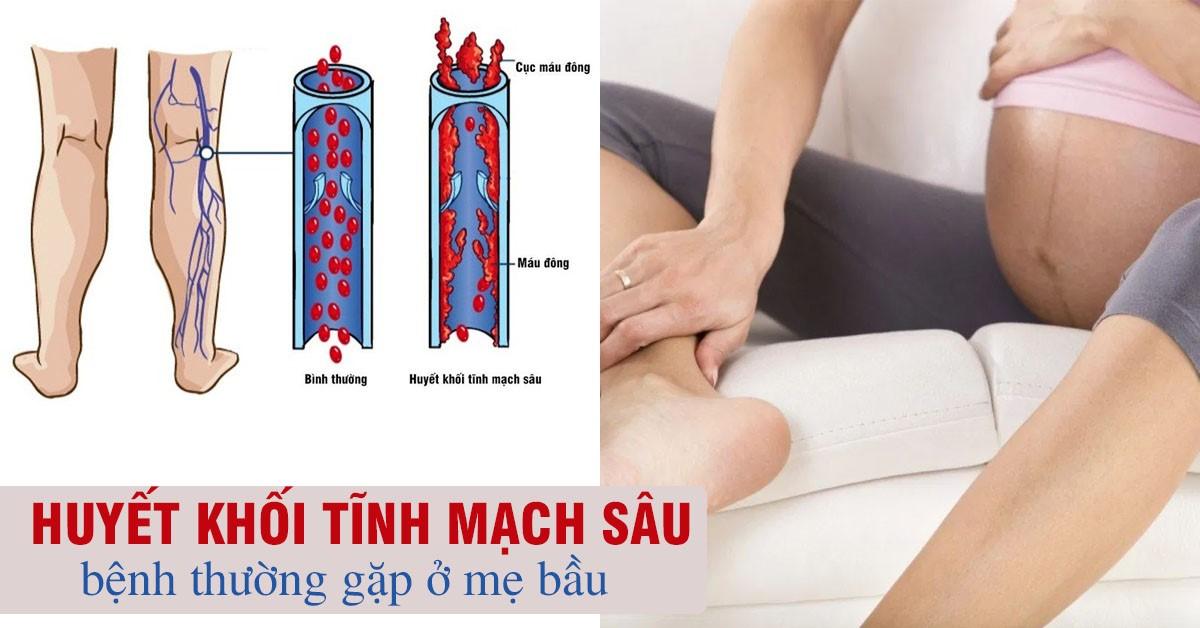 Tìm hiểu về bệnh huyết khối tĩnh mạch trong thai kỳ