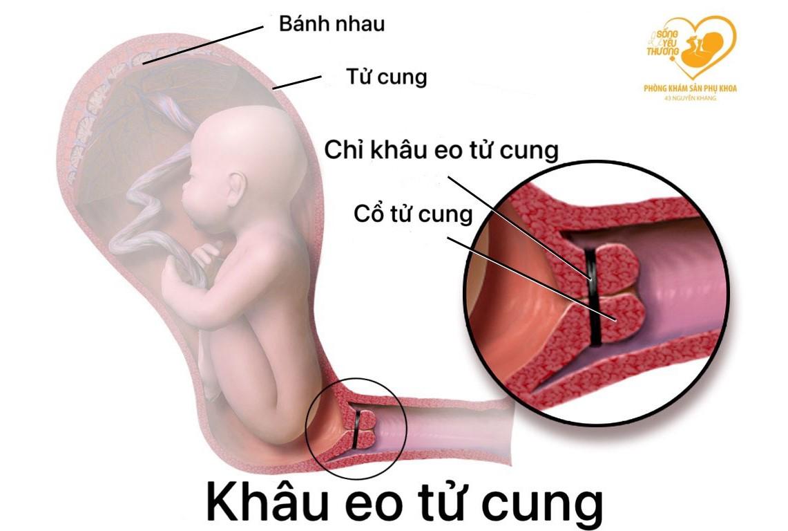 Thời điểm tốt nhất để thực hiện khâu eo cổ tử cung?