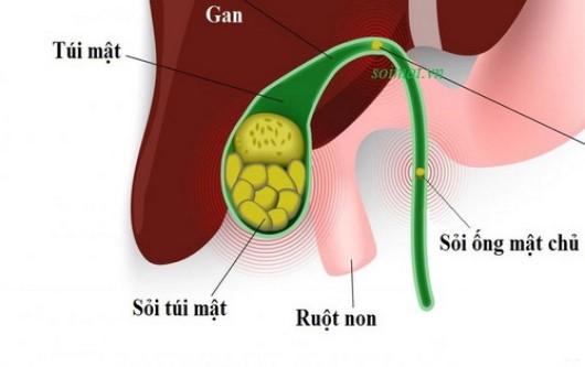 Sỏi túi mật khi mang thai và những điều cần biết?