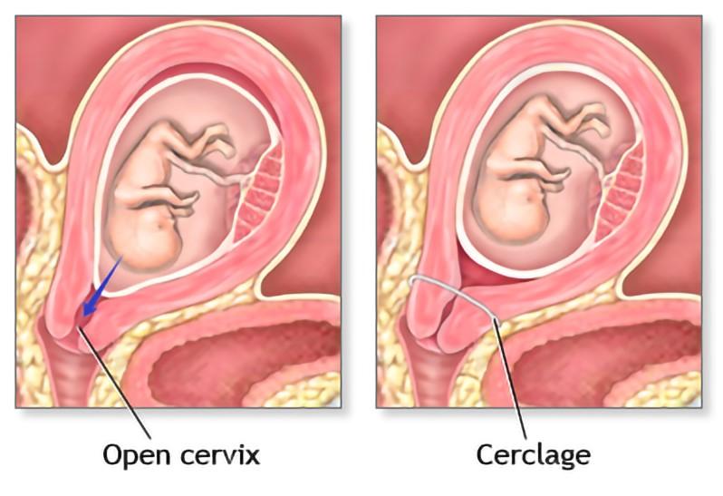 Trường hợp nào cần khâu vòng cổ tử cung