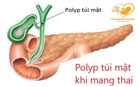 Polyp túi mật khi mang thai