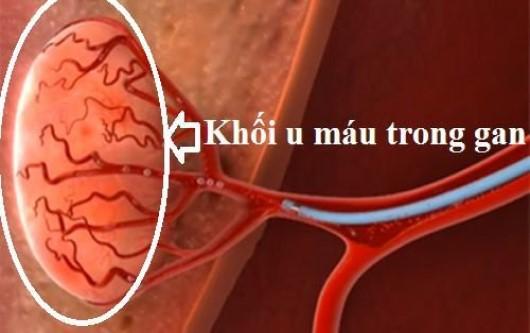 U máu trong gan có nguy hiểm không?