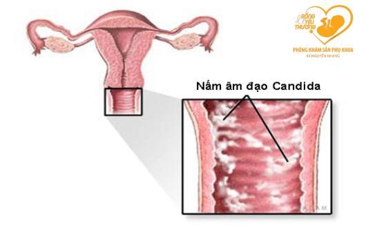 Viêm âm đạo do nấm candida và những điều phụ nữ cần biết?