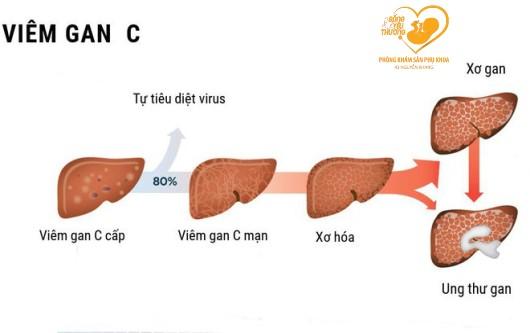 Viêm gan C có nguy hiểm không?