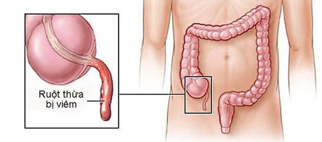 Triệu chứng nhận biết viêm ruột thừa