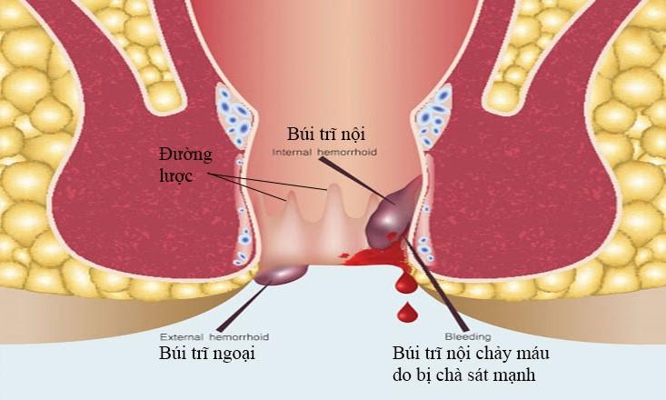 Bệnh trĩ khi mang thai-nỗi khổ khó nói của mẹ bầu