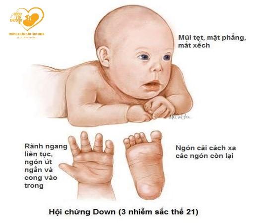 Tìm hiểu về hội chứng Down
