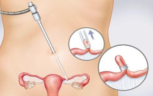 Phương pháp triệt sản ở nữ - Thắt ống dẫn trứng 