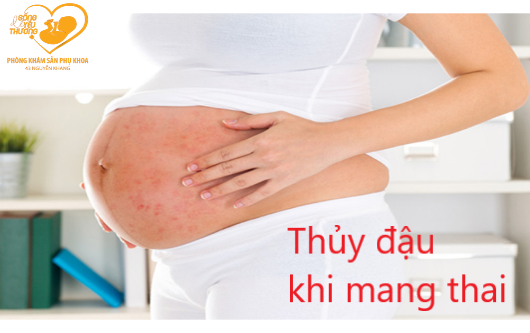 Thủy đậu khi mang thai